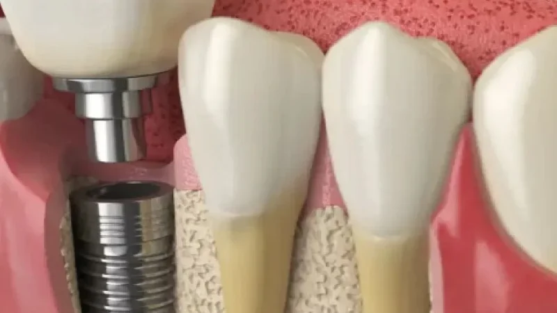 Implant Dental Vs. Dentures - The Honest Comparison