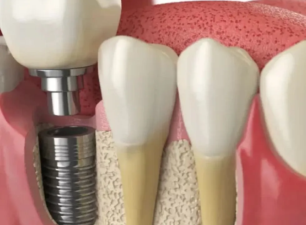 Implant Dental Vs. Dentures – The Honest Comparison
